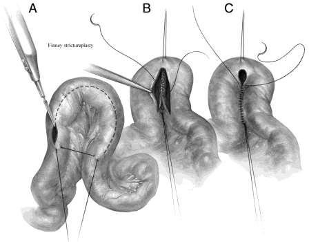 Ν.Crohn: