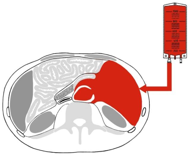 normotensive resuscitation )