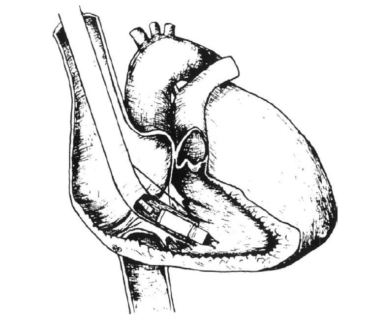 History of Leadless Pacing: Miniature Pacemaker Tested in 1991 5.