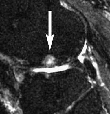 Severity and distribution of cartilage damage and bone