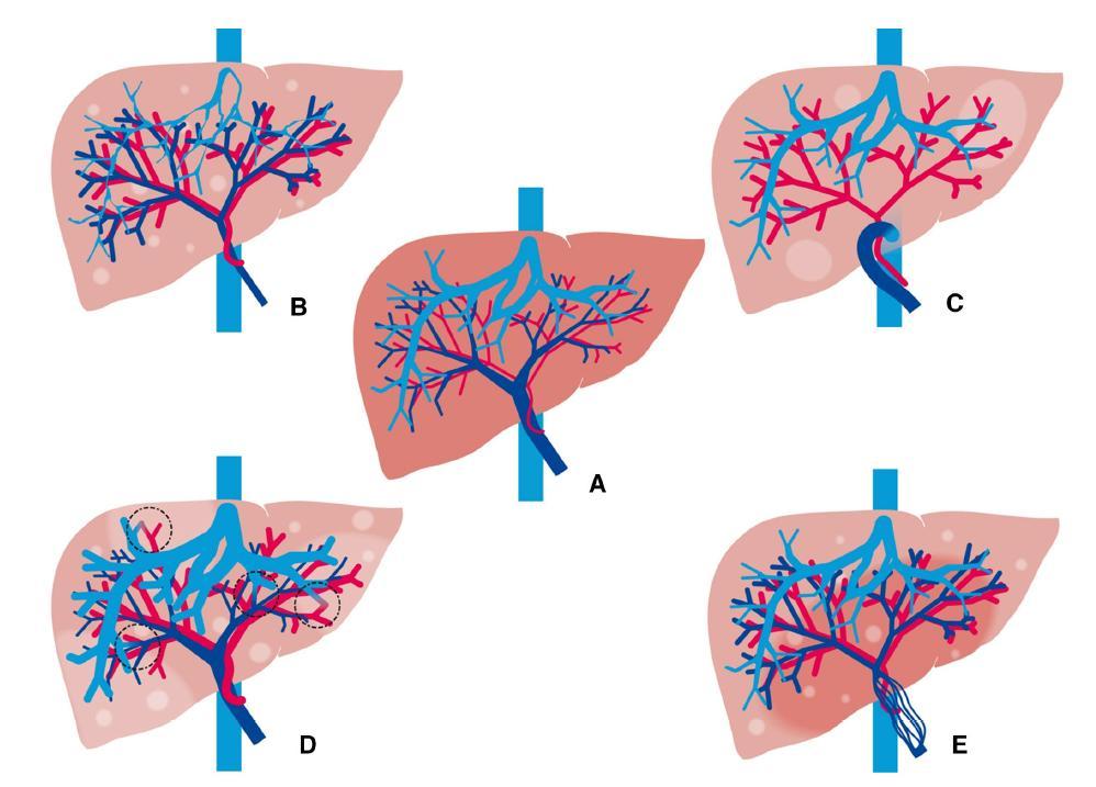 Budd-Chiari