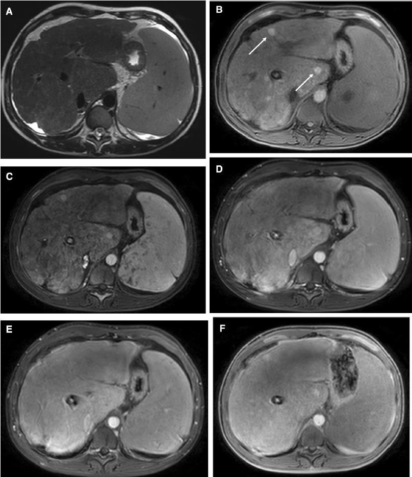 T2-weighted MR imaging, Fat-suppressed T1- weighted MR contrast-enhanced