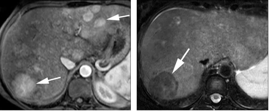 MRI ήπατος: ευρήματα σε πρωτοπαθές BCS T1 MR ακολουθία
