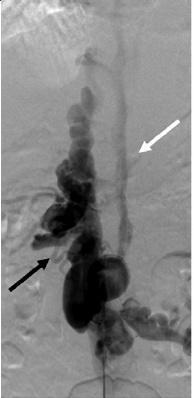 αγγειοπλαστική +stent επιβίωση σε 1, 5 και