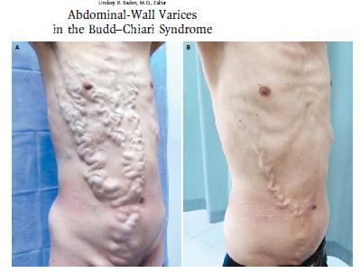Αγγειοπλαστική +stent σε ασθενή με BCS Α. BCS με θρόμβωση κάτω κοίλης φλέβας Β.