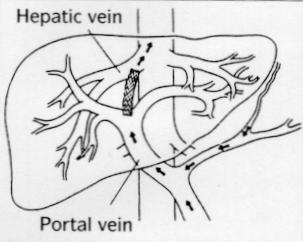 Θεραπεία 3 ης γραμμής για BCS: TIPPS (Transjugular intrahepatic portosystemic shunt) αποτελεί το επόμενο βήμα σε ασθενείς που δεν έχουν ανταποκριθεί στην προηγηθείσα