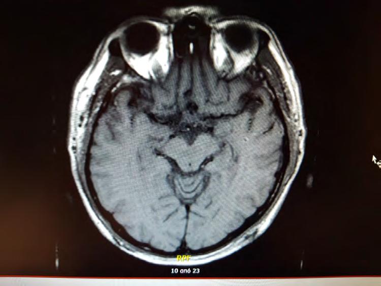MRI