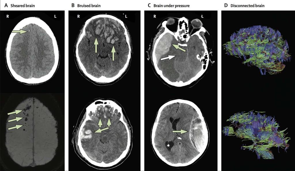 Βαριά ΚΕΚ- Τι κάνουμε τώρα; The Lancet Neurology