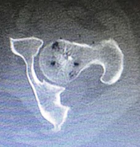Bone CT Φυσαλίδες αέρα και διαταραχή