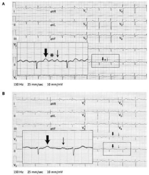 "T-U-P" syndrome, or pseudoatrial