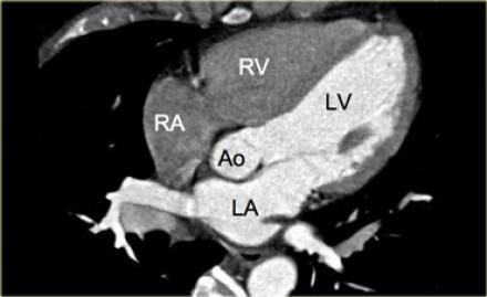 Αριστερό διάφραγμα Μη στεφανιαία πτυχή P waves from the atrial septal region - these tachycardias were ablated from the left septum and noncoronary cusp (NCC) respectively.