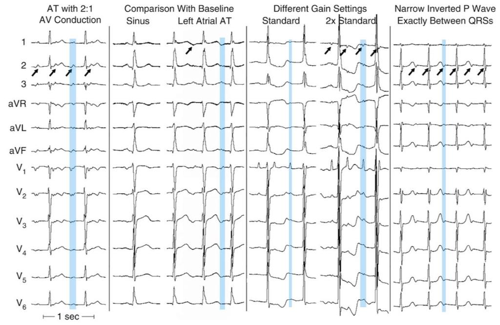 Cardiac Electrophysiology: From