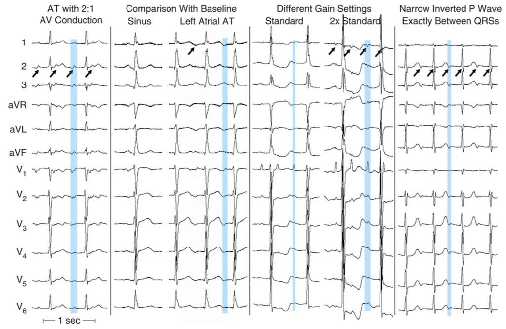 Cardiac Electrophysiology: From