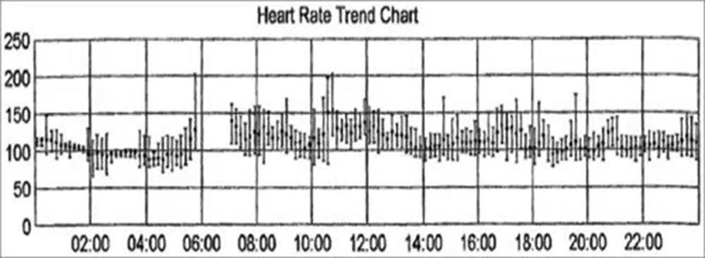 Απρόσφορη φλεβοκομβική ταχυκαρδία Οι ασθενείς με IST γενικά έχουν ημερήσιες συχνότητες άνω των 100bpm και μέση καρδιακή συχνότητα 24