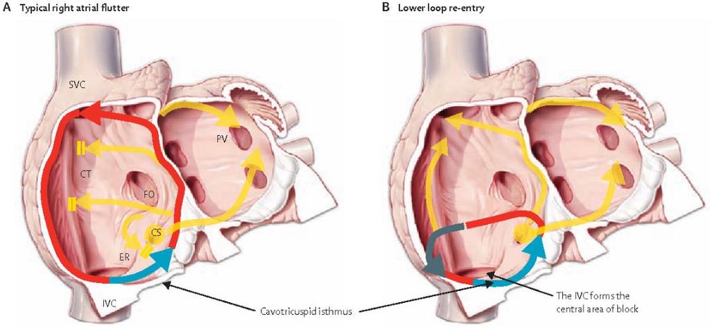 Ταχυκαρδία επανεισόδου κατωτέρου βρόχου Μια εξαρτώμενη από τον ισθμό ΚΚΦ-τργλώχινας και μπορεί να περιστραφεται είτε αριστερόστροφα είτε δεξιόστροφα γύρω από την κατώ κοίλη φλέβα σπάζοντας διαμέσου