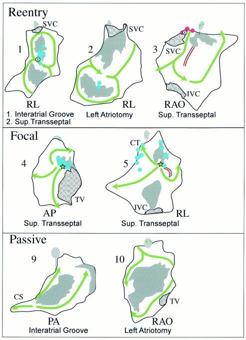 tachycardias related to mitral valve