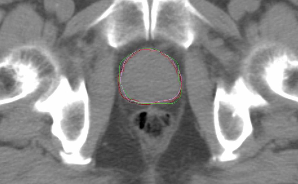 radiation therapy. Nevertheless, a small number of patients during these 9 months underwent radical 3D conformal Radiation Therapy having an intact prostate.