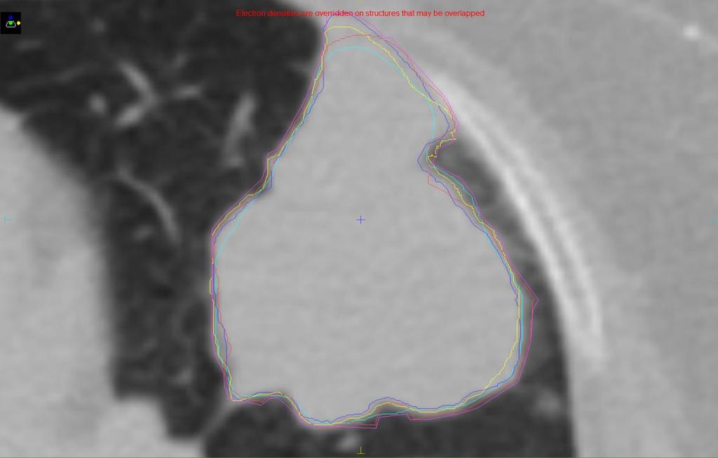 Figure 2.9: Contours of lung delineation Figure 2.10: Contours of brain delineation Regarding brain, patients undergoing EBRT were only a few during this 9 month period.
