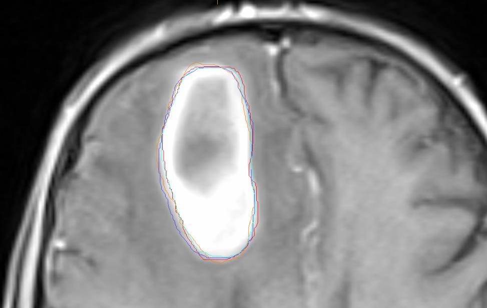 Like before, two typical and representative cases of brain malignancies were selected.