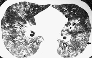 Aλλογενής HSCT Διάσπαρτη θολή ύαλος Κεντρολοβιώδη οζίδια Hall CB, NEJM 2001 Kanne JP, J Thorac Imaging 2007 AΔΕΝΟΪΟΙ Βαρεία