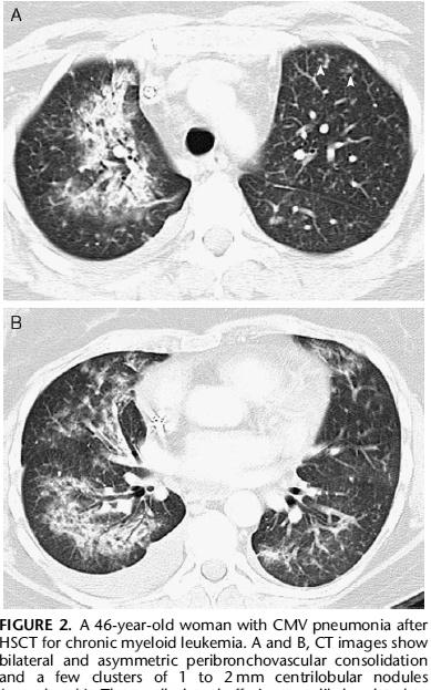with cytomegalovirus pneumonia.