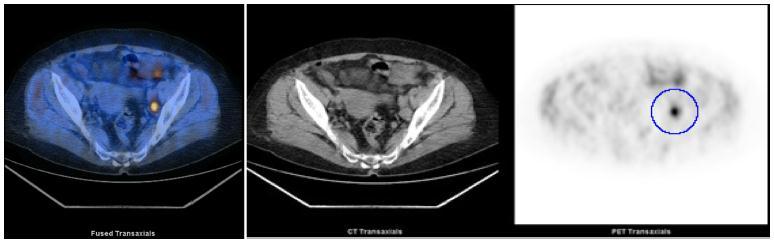 Απεικόνιση Προεγχειρητικά Follow-up CT, MRI: Eυασθησία 40-85% PET/CT: Eυασθησία 60%