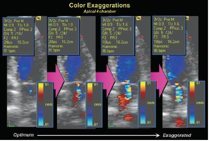 Settings of Color Doppler gain jet color gain jet velocity Nyquist jet frame rate jet persistence jet Ηχωκαρδιογραφικά