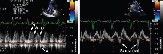 atrial fibrillation Not accurate if MR directed into