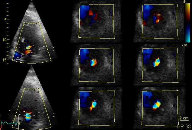 Vena contracta area Severe MR to have a cut-off value of 3D vena