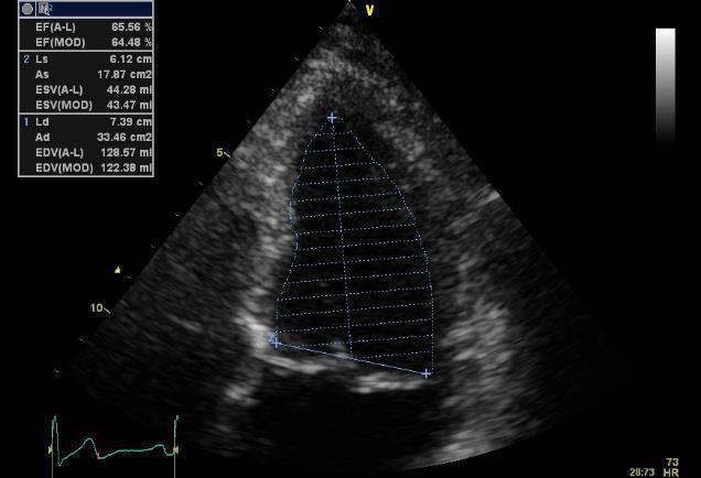 arrhythmia, SAP