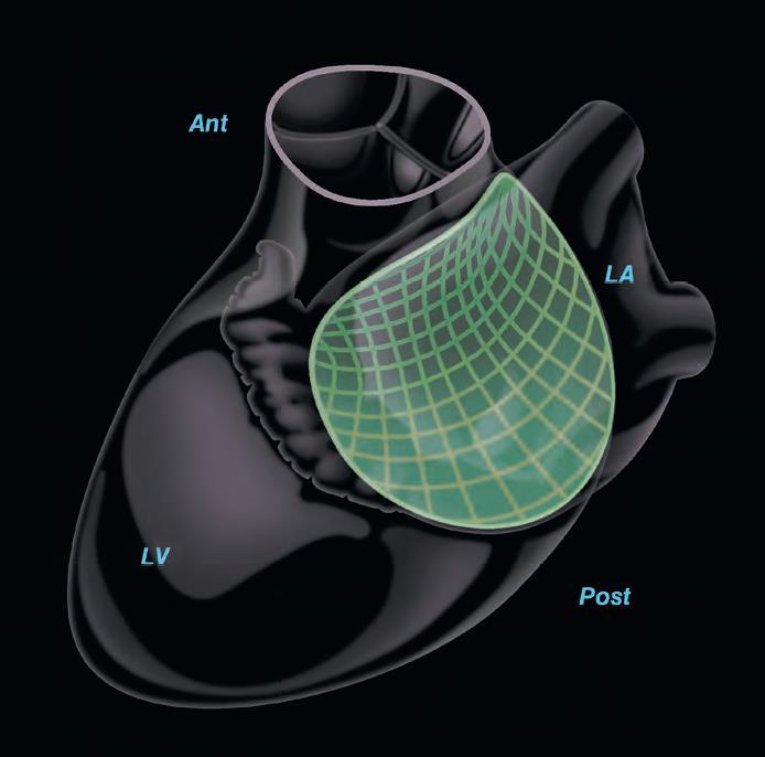 Mitral annulus The saddle shape is optimal for minimizing stress