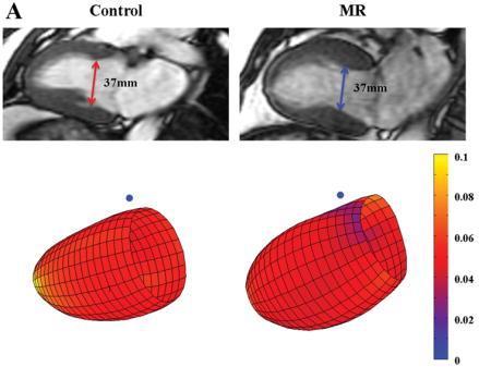 LV Remodeling in Primary MR n=94 MR patients, LVEF>60%,