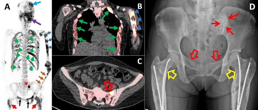 Σκελετική Απεικόνιση με F-NaF PET/CT Καλοήθη Νοσήματα