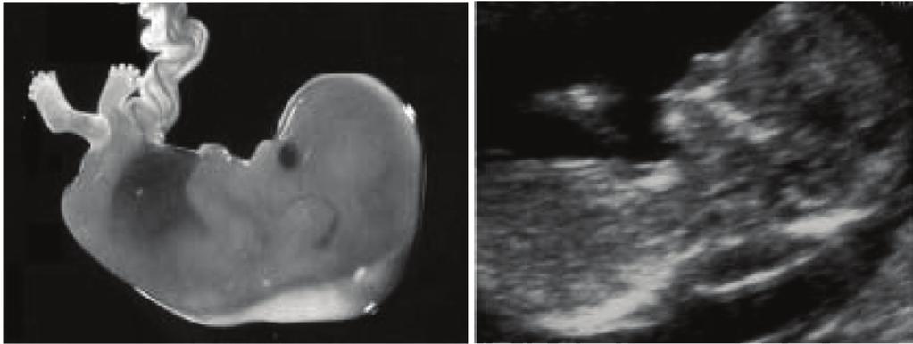 Εικόνα 3. (α) Έμβρυο με υποδόρια συλλογή υγρού στον αυχένα. (β) υπερηχογραφική εικόνα εμβρύου 12 εβδομάδων με αυξημένη αυχενική διαφάνεια [Nicolaides ΚΗ.