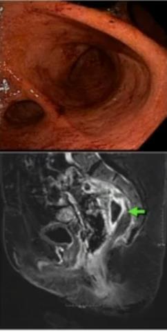 Παράκμψη μόνο/ loop ειλεοστομια Κίνδυνος pouchitis και σήψης στην πύελο Κάποια μορφή ακράτειας/απώλεια βλέννης Πόνος Υψηλή παροχή από τη