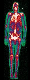 απεικόνιση με χρήση ραδιοϊσοτόπων απεικόνιση της διαφορικής κατανομής ραδιοϊσοτόπων (=ραδιενεργών πυρήνων) στο ανθρώπινο σώμα απεικόνιση εκπομπής