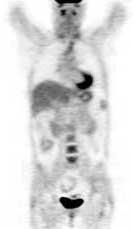 F-deoxyglucose whole-body PET scan www.ucair.med.utah.