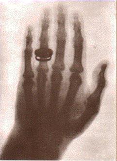 22 Δεκεμβρίου 1895 το χέρι της συζύγου του Roentgen η πρώτη