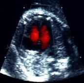 διαγνωστική και μοριακή απεικόνιση με υπέρηχους υπερηχοτομογραφία καρδιά εμβρύου (27 βδομάδα κύησης) www.