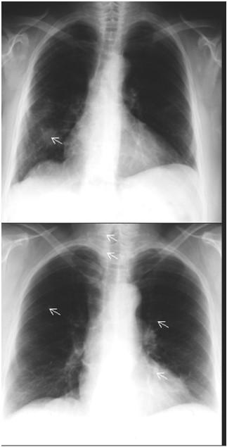 Aκτινογραφία θώρακος Δύο περιπτώσεις με