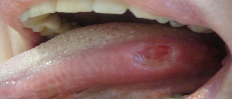 φυματίνης)= 0mm PFTS: FVC: 2.07 (54%), FEV1: 1.96 (60%), FEV1/FVC: 91%, TLC: 2.37 (56%), DLCO: 3.