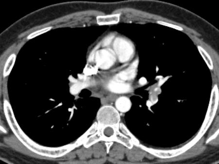 Pulmonary