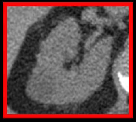 cyst CT