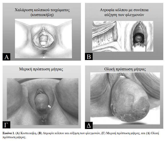 Εικόνα 9: Επιπτώσεις της εμμηνόπαυσης στο ουροποιητικό σύστημα Η χρόνια έλλειψη των οιστρογόνων συνδέεται, λόγω στροφίας και μειωμένης αντίστασης σε βακτηριδιακές λοιμώξεις, με υποτροπιάζουσα