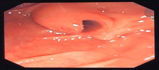 Ετήσιο ρυθμός προόδου σε HGD ή Ca (1,4-6,9 %) surveillance. Tanaka et al. Pancreatology 2017: 17: 738-53.