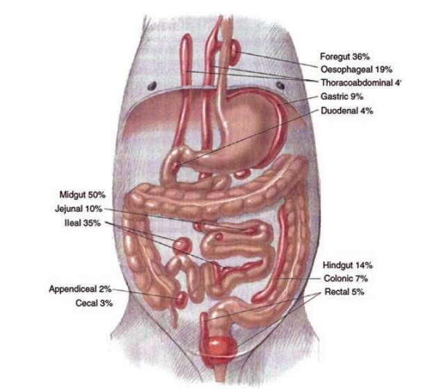 4.3. Διπλασιασμοί του πεπτικού (Alimentary Tract Duplications) 4.3.1.