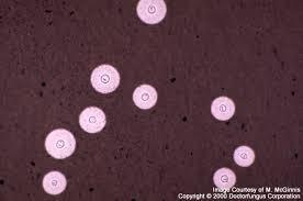 Λοιμώξεις κρυπτοκοκκική μηνιγγίτις Μυκητιασική λοίμωξη Cryptococcus neoformans CD4 < 50 Συχνή, προσδιοριστική του AIDS Εκδηλώσεις: κεφαλαλγία(75%), πυρετός(65%), διαταραχή συμπεριφοράς(40%),