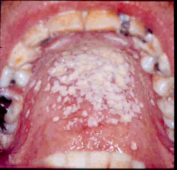 Λοιμώξεις Candida sp Στοματίτιδα: διαταραχή γεύσεως, πόνος στην κατάποση λευκωπές πλάκες ή ερυθρωπές περιοχές στο βλεννογόνο του στόματος ή γωνιακή χειλίτις 80% υποτροπιάζουσα, ένδειξη προφύλαξης