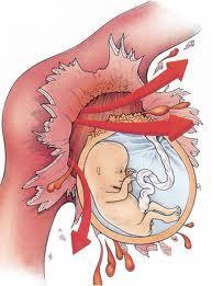 Εξωμήτρια κύηση Σε σπάνιες περιπτώσεις το γονιμοποιημένο ωάριο παραμένει μέσα στη σάλπιγγα. (Εξωμήτρια κύηση).