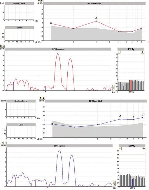 Νευροϊνωμάτωση τύπου 2 και αιφνίδια βαρηκοΐα Εικ. 2 Οι ωτοακουστικές εκπομπές προϊόντων παραμόρφωσης (DPOAEs-gram 65 db) ακολουθούν την καμπύλη του τονικού ακοογράμματος αμφοτερόπλευρα. Εικ. 3 Καταγραφή των click ABR.